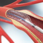 3d_illustration_of_stent_implantation_for_supporting_blood_circulation_into_blood_vessels